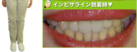 インビザライン脱着時